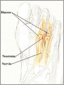 neuroma de morton